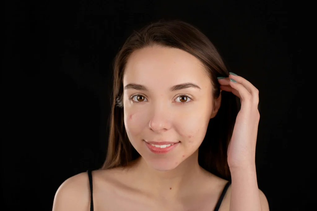 Overnight pimple patches for acne healing