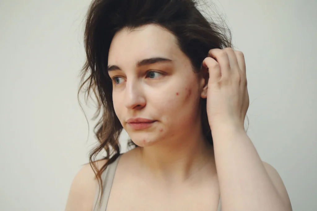 Woman with acne-prone skin following a gentle skincare routine