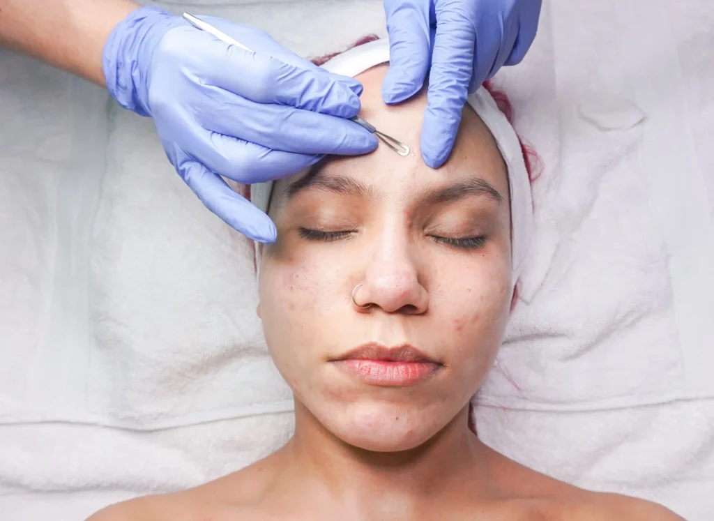 Benzoyl peroxide cream for acne treatment with minimal skincare background