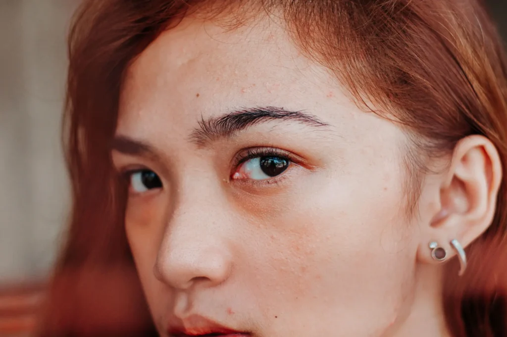 Woman moisturizing dry skin to improve hydration and skin barrier